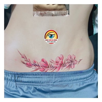 che sẹo cho chị tự tin hơn
