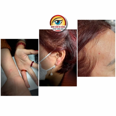 Nốt ruồi phong thủy cho chị khách